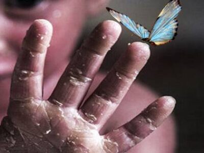۱۹ بیمار پروانهای در استان قم شناسایی شد